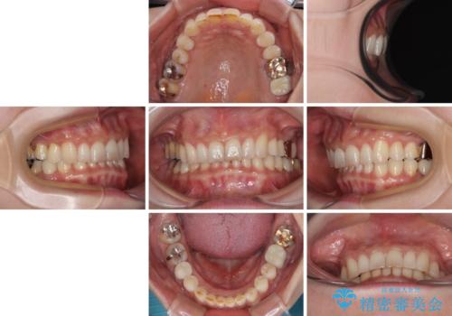 デコボコの歯とむし歯 インビザライン矯正治療とむし歯治療の治療後