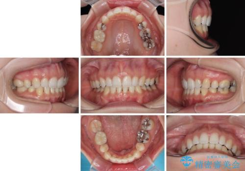 顎先に梅干し皺ができる　閉じにくい唇を抜歯矯正で閉じやすくの治療後