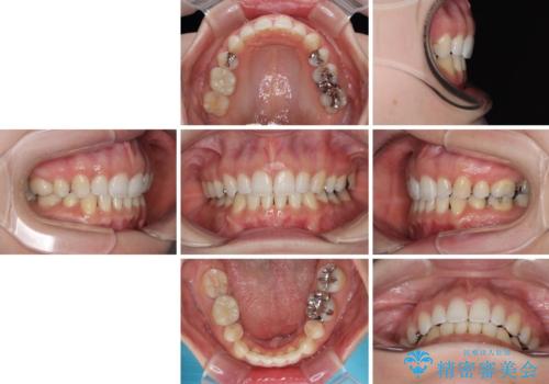 顎先に梅干し皺ができる 閉じにくい唇を抜歯矯正で閉じやすくの治療後