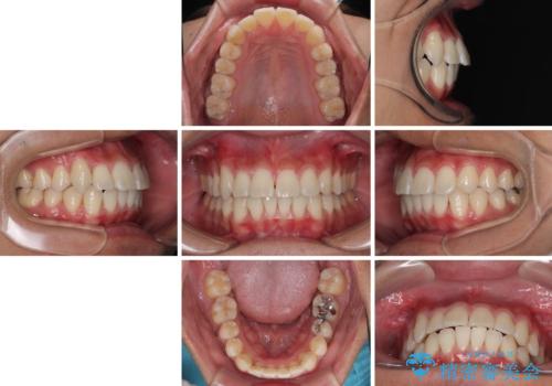八重歯を無理なくなおしたい　ワイヤー装置による非抜歯矯正治療の治療後