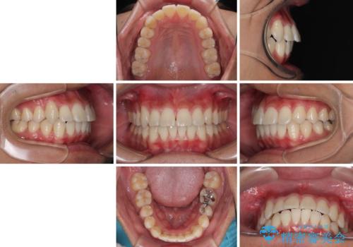 八重歯を無理なくなおしたい ワイヤー装置による非抜歯矯正治療の治療後