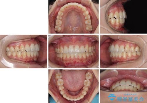 急速拡大装置　狭い歯列を拡大してワイヤー装置で短期間治療の治療後