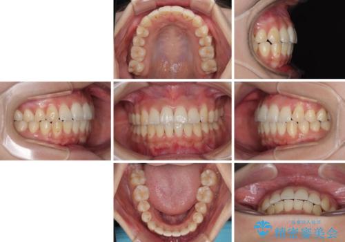 急速拡大装置 狭い歯列を拡大してワイヤー装置で短期間治療の治療後