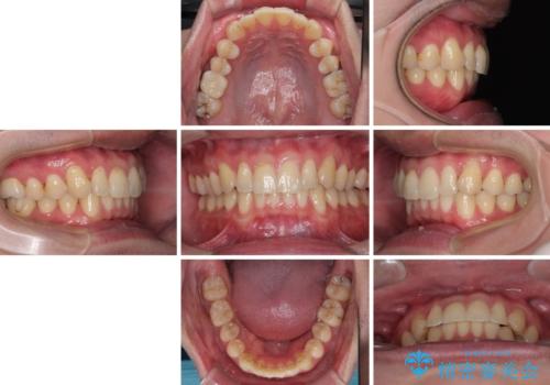 上下のデコボコを治したい インビザラインによる矯正治療の治療後