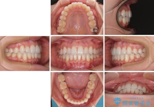 【モニター】インビザラインで気になるデコボコと八重歯をきれいに整えるの治療後