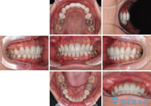 薬剤の影響で変色した歯を自然に オールセラミッククラウンによる審美歯科治療の治療後