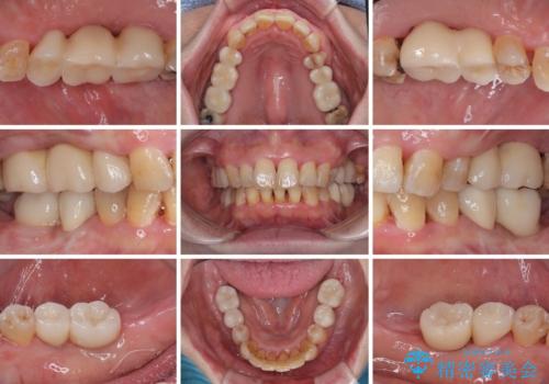 治療中で放置　インプラントでしっかりと咬めるようにの治療後