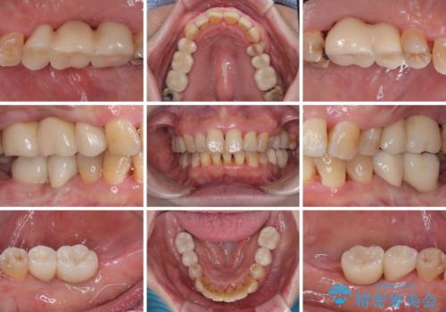 治療中で放置 インプラントでしっかりと咬めるようにの治療後