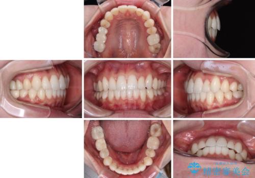 ワーキングホリデー前にきれいな歯列にの治療後