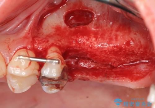 虫歯・破折の放置により重度に吸収した歯槽骨　骨造成後のインプラント治療の治療中