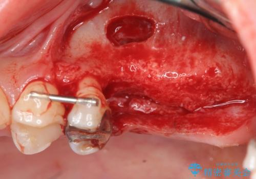 虫歯・破折の放置により重度に吸収した歯槽骨 骨造成後のインプラント治療の治療中