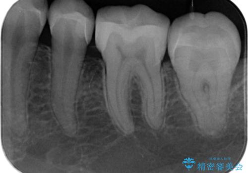 詰め物の治療。の治療後