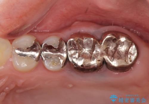 虫歯・破折の放置により重度に吸収した歯槽骨 骨造成後のインプラント治療の治療前