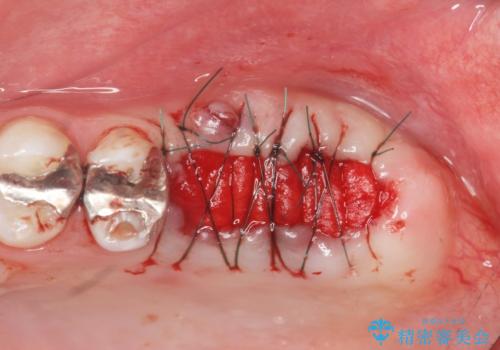 虫歯・破折の放置により重度に吸収した歯槽骨 骨造成後のインプラント治療の治療前