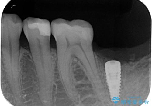 歯からの異臭　虫歯の再発からのインプラント治療の治療中