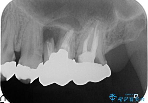 虫歯・破折の放置により重度に吸収した歯槽骨 骨造成後のインプラント治療の治療前