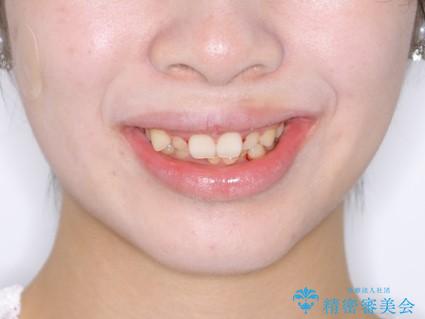 前歯のがたつきとディープバイト:インビザライン治療の治療前(顔貌)