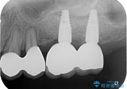 虫歯・破折の放置により重度に吸収した歯槽骨　骨造成後のインプラント治療の治療後