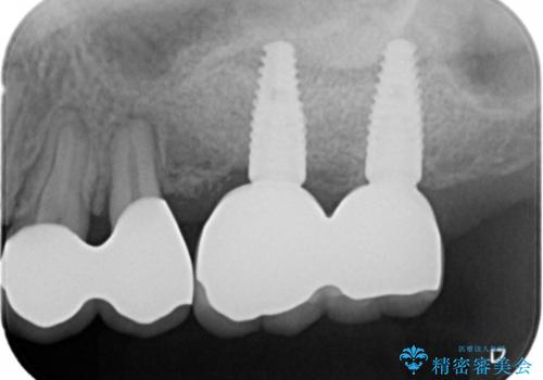 虫歯・破折の放置により重度に吸収した歯槽骨 骨造成後のインプラント治療の治療後