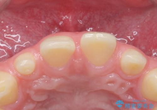 前歯の隙間を埋めたい　矯正かクラウンかの治療前