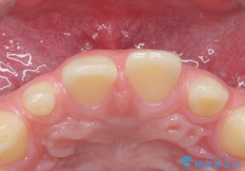 前歯の隙間を埋めたい 矯正かクラウンかの治療前