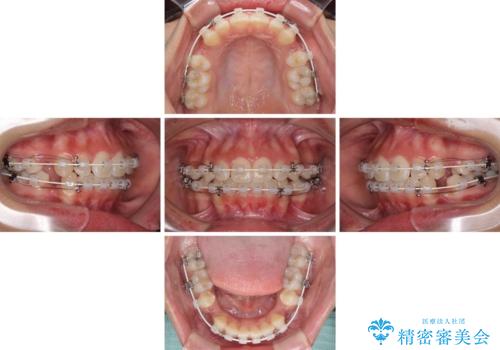 くちばしのように突出した前歯　口元を下げる抜歯矯正の治療中