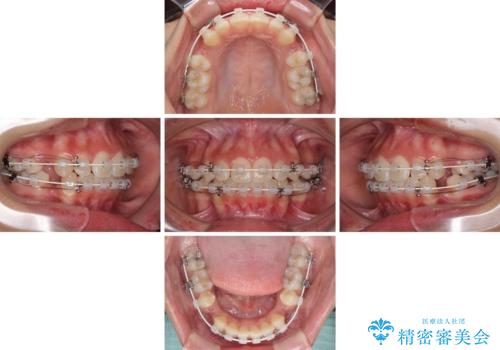 くちばしのように突出した前歯 口元を下げる抜歯矯正の治療中