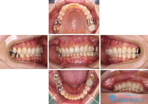 デコボコの歯とむし歯 インビザライン矯正治療とむし歯治療の治療中