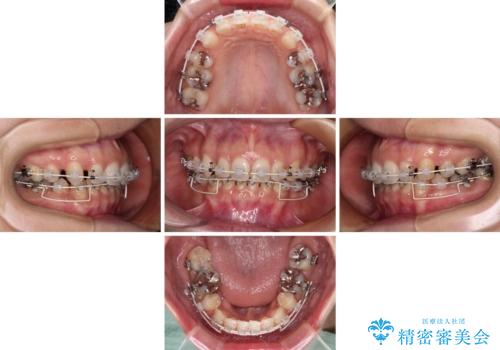 顎先に梅干し皺ができる　閉じにくい唇を抜歯矯正で閉じやすくの治療中