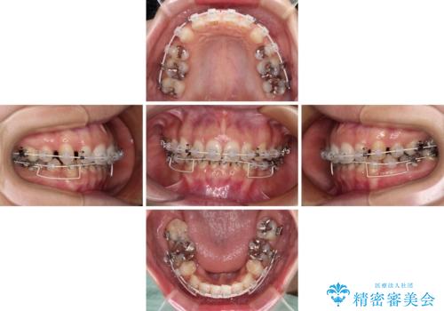 顎先に梅干し皺ができる 閉じにくい唇を抜歯矯正で閉じやすくの治療中