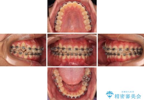 八重歯を無理なくなおしたい　ワイヤー装置による非抜歯矯正治療の治療中