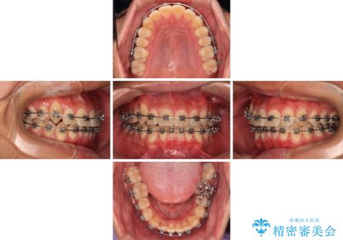 八重歯を無理なくなおしたい ワイヤー装置による非抜歯矯正治療の治療中