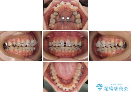 急速拡大装置　狭い歯列を拡大してワイヤー装置で短期間治療の治療中
