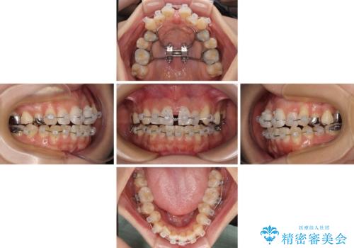 急速拡大装置 狭い歯列を拡大してワイヤー装置で短期間治療の治療中