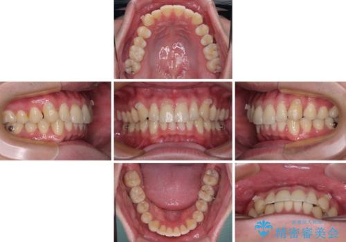 上下のデコボコを治したい インビザラインによる矯正治療の治療中