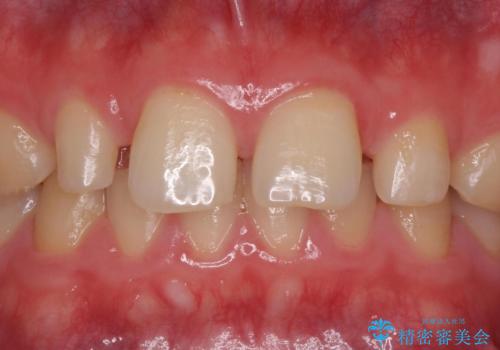 前歯の隙間を埋めたい 矯正かクラウンかの症例 治療前