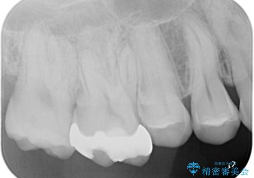 【奥歯のセラミッククラウン】他院で根管治療も必要だといわれた。の治療前