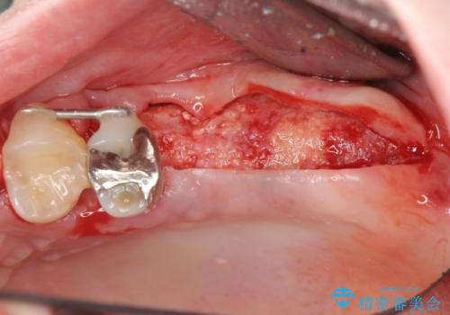 虫歯・破折の放置により重度に吸収した歯槽骨　骨造成後のインプラント治療の治療中