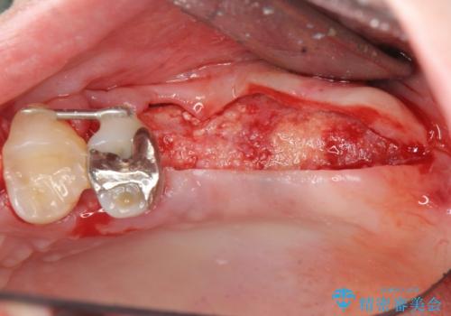虫歯・破折の放置により重度に吸収した歯槽骨 骨造成後のインプラント治療の治療中