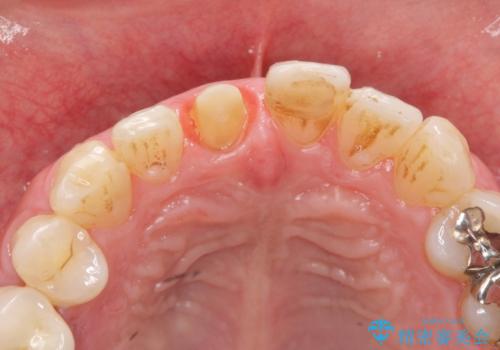 前歯の変色を改善 オールセラミック治療の治療中