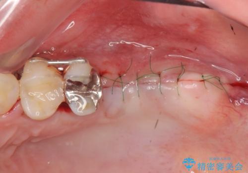 虫歯・破折の放置により重度に吸収した歯槽骨 骨造成後のインプラント治療の治療中