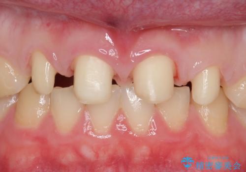 前歯の隙間を埋めたい 矯正かクラウンかの治療中