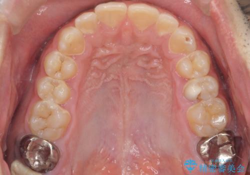 できる限り口の中を綺麗にしたい。の症例 治療前