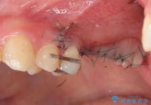 虫歯・破折の放置により重度に吸収した歯槽骨 骨造成後のインプラント治療の治療中