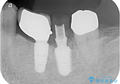 【1Dayインプラント治療! 低侵襲で短期間での治療】 咬むと歯が痛い! 歯根破折の治療中