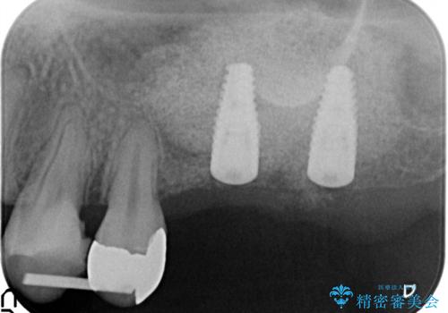 虫歯・破折の放置により重度に吸収した歯槽骨　骨造成後のインプラント治療の治療中