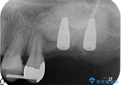 虫歯・破折の放置により重度に吸収した歯槽骨 骨造成後のインプラント治療の治療中