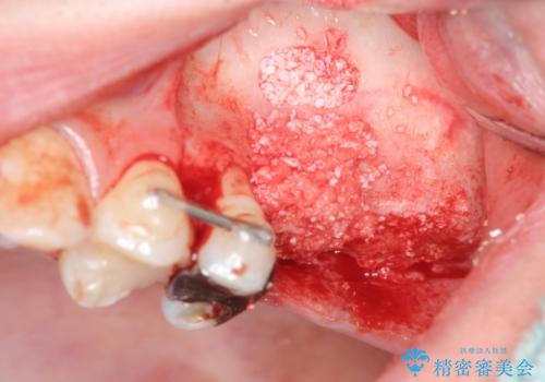 虫歯・破折の放置により重度に吸収した歯槽骨 骨造成後のインプラント治療の治療中