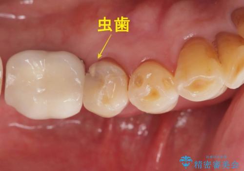 【オールセラミッククラウン】虫歯で歯が欠けた!の治療前