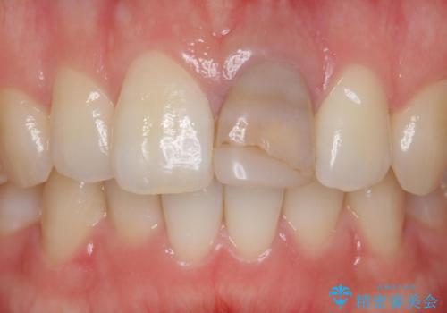 前歯が暗く変色 ジルコニアクラウンでの修復の治療前